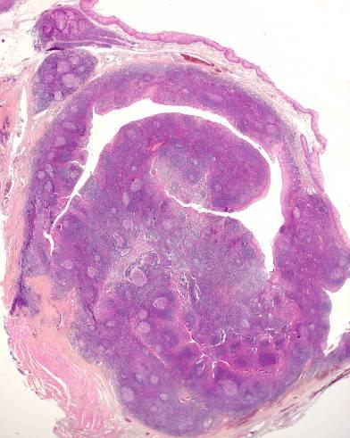 MALT Tissu Lymphoïde Associé aux Muqueuses