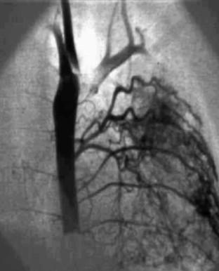vascularisation systémique de vicariance - Analyse du poumon