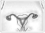 4 Stérilisation à visée contraceptive La stérilisation : les méthodes et leurs conséquences La stérilisation féminine ou masculine est un acte chirurgical, réalisé par un médecin en établissement de