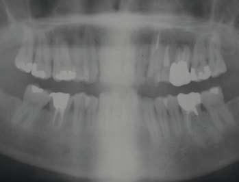Les implantologistes ont tranché, ils préfèrent un implant, mais ils n ont jamais préparé orthodontiquement et endodontiquement le transplant comme nous l avons fait. 2.
