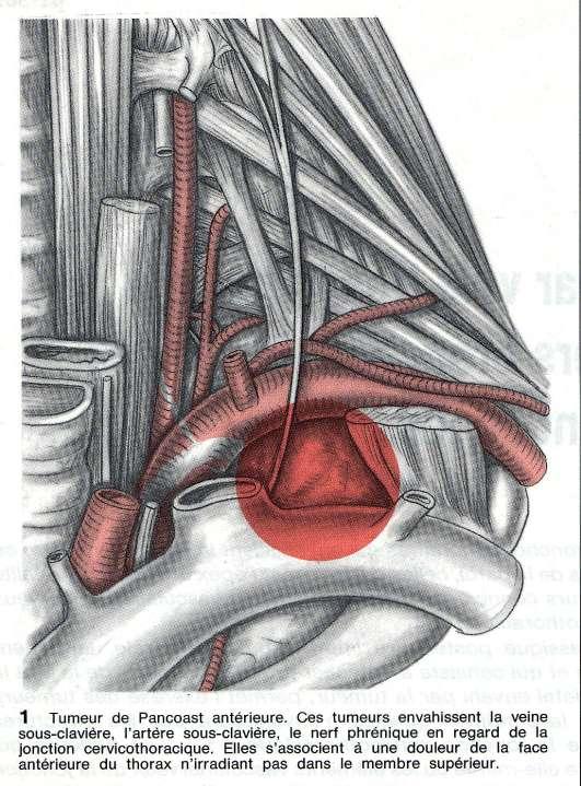 Nerf phrénique Envahissement vasculaire antérieur