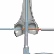 400 mm (80122) dans la vis à compression pour déterminer l emplacement de l incision sur le coté médial.