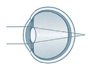 L OEIL HYPERMÉTROPE L hypermétropie L oeil hypermétrope est habituellement plus court que la normale ou présente une courbure trop aplatie de la cornée.