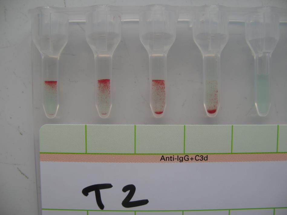 TECHNIQUE DE MICROTITRAGE Technique simple d hémagglutination en support gel 6 ng/ml