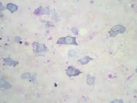 500). 3b. Critères de malignité : mitoses (flèche rouge), rapport nucléocytoplasmique variable, moyen à élevé, anisocytose et anisocaryose sévères, nombreux nucléoles visibles.