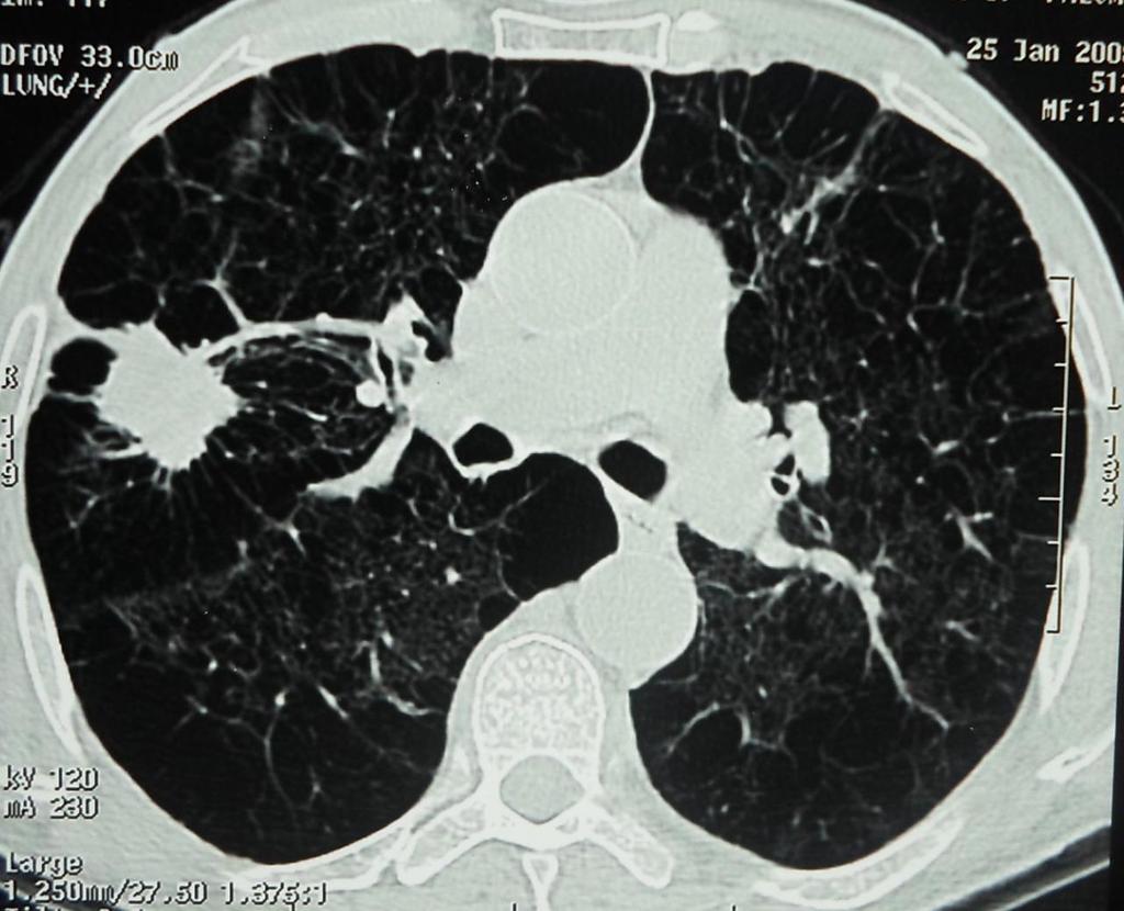 T1 Tumeur de 3 cm ou moins, entourée de parenchyme pulmonaire ou de plèvre, sans invasion