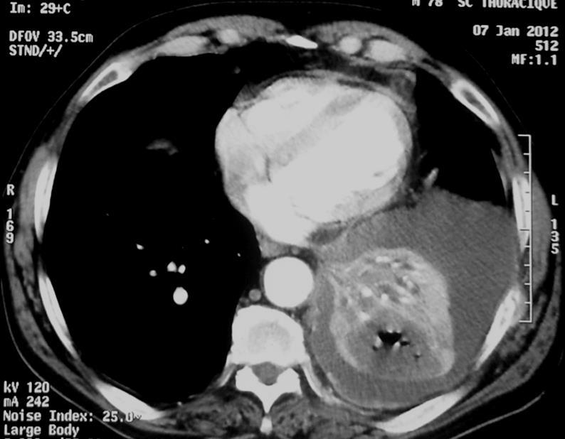 T2 a Processus tumoral proximal de taille < 5 cm obstruant la bronche