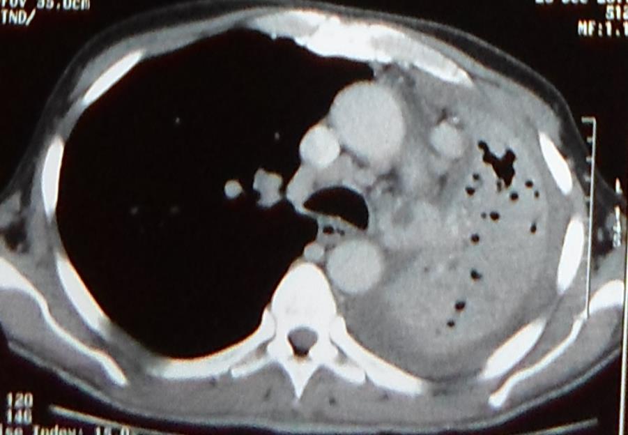 T3 Pneumonie obstructive du poumon entier Masse tumorale proximale