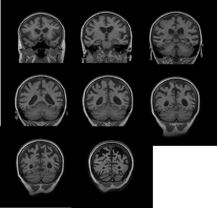 Illustration 3 : IRM encéphalique de 2010 en séquence T1, en coupe coronale Atrophie corticale pariétale majeure,