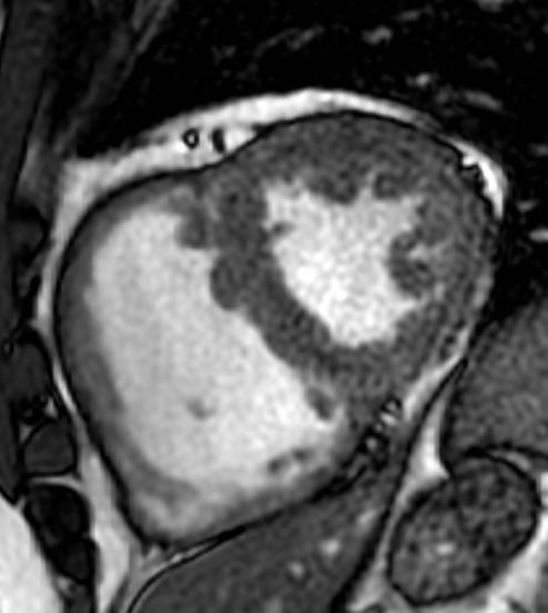 Magnetic resonance imaging of abnormal ventricular