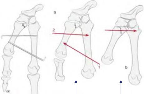 impératif absolu ; seules les fractures articulaires ont des exigences de réduction plus strictes.