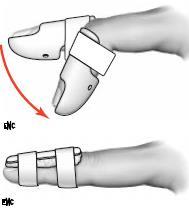 Lésion récente des tendons extenseurs des doigts longs : devant une lésion du dos de la main ou des doigts longs, un examen de l extension active est insuffisant et l exploration chirurgicale