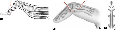 latérales qui peuvent initialement compenser le déficit d extension : plaie tendineuse, rupture sous-cutanée Traitement : orthopédique ou chirurgical Lésion ancienne des tendons extenseurs des doigts