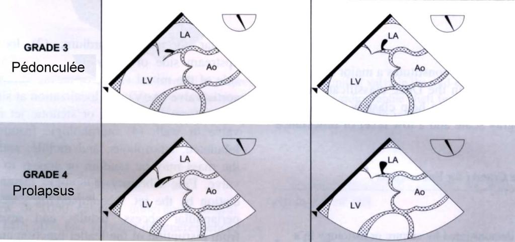 valve ne passe pas le plan de l anneau mitral) Rupture / élongation de cordage Rupture