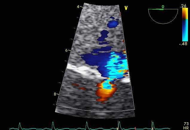 Surface de l orifice régurgitant (SOR) Analyse du flux veineux pulmonaire Doppler continu vr SIM = 2πr