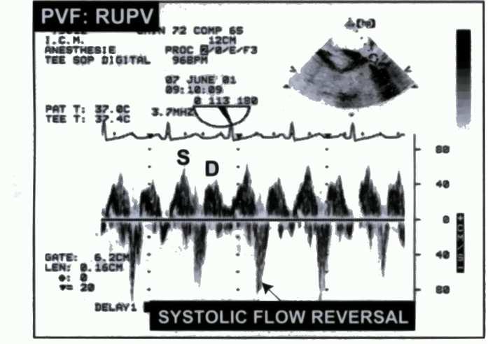3-4 VC> 6mm INVERSION FLUX SYSTOLIQUE VTI mitrale/ VTI aortique Severite de l IM Paramètres VTI