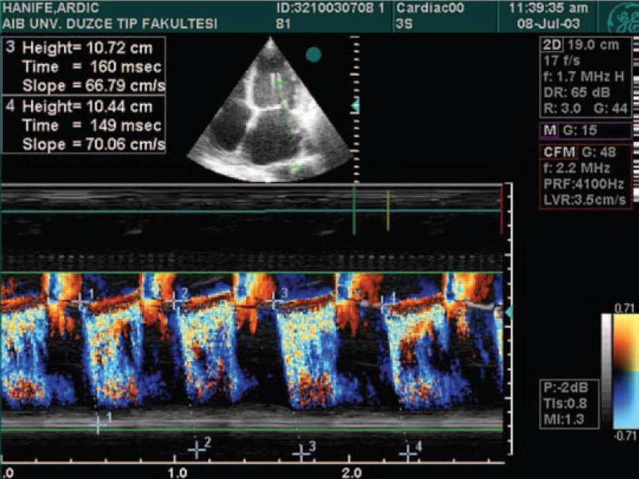 2 m/s Veines pulmonaires Flux normal syst Diminution du flux syst Inversion du flux systolique