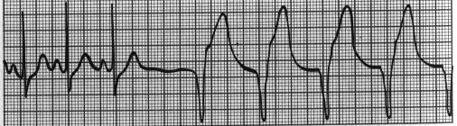 Tachycardie ventriculaire Traitement Choc