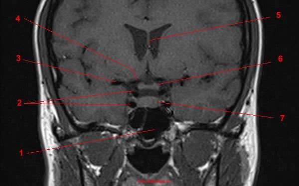 T1, coupe sagittale 1 : pôle frontal 2 : corps calleux 3 : ventricule latéral