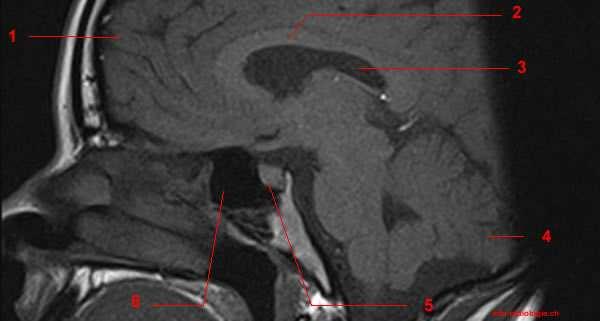 sphénoïdale 2 : artère carotide interne 3 : artère cérébrale moyenne 4 :