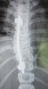 Eric Nectoux Scolioses congénitales moelle attachée, une échographie abdominale et de l appareil rénal et urinaire, une échographie cardiaque.