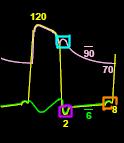 III. Mesures de l'activité cardiaque a. Les pressions cardiaques Cavités gauches: encadré bleu: onde dicrote qui correspond à la fermeture de la sigmoïde aortique.