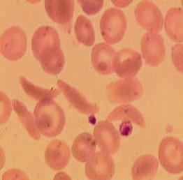 Document 2 : Globules rouges ou hématies Globules blancs Doc2 a Doc 2b Document 3 : L hémoglobine est la protéine dissoute la plus abondante du cytoplasme des hématies.