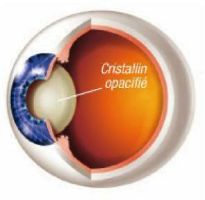L opération de la cataracte (1) consiste à enlever le cristallin naturel, devenu moins transparent.