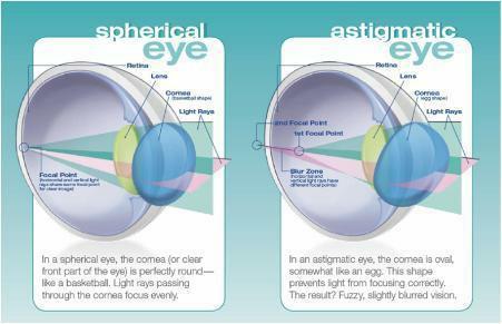 La chirurgie de la cataracte réglant par l ablation du cristallin le problème de l astigmatisme interne, il persiste celui de l astigmatisme cornéen.