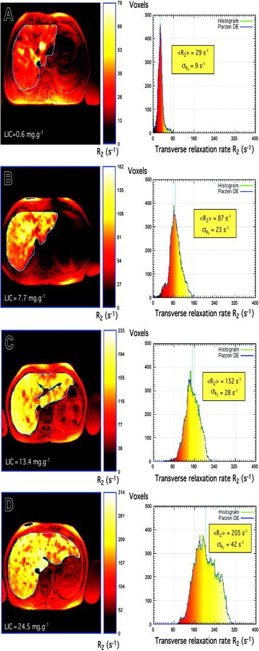 Méthodes d évaluation de la surcharge en fer - LIC (mg Fe/g dry tissue) Corrélation entre IRM hépatique et biopsie hépatique (LIC) 50 40