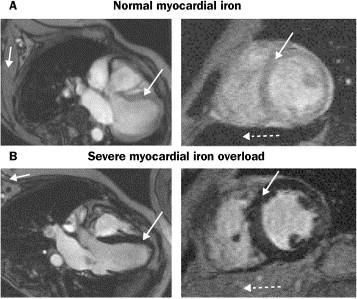 cardiaque (IRM T2* : 50-60ms) A Normal myocardial iron B