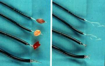 La bronchoscopie souple permet d enlever les CE à l aide de différents instruments (pince, panier, etc..) elle est proposée chez l adulte si le CE n est pas trop volumineux (figure 7) Figure 7 V.