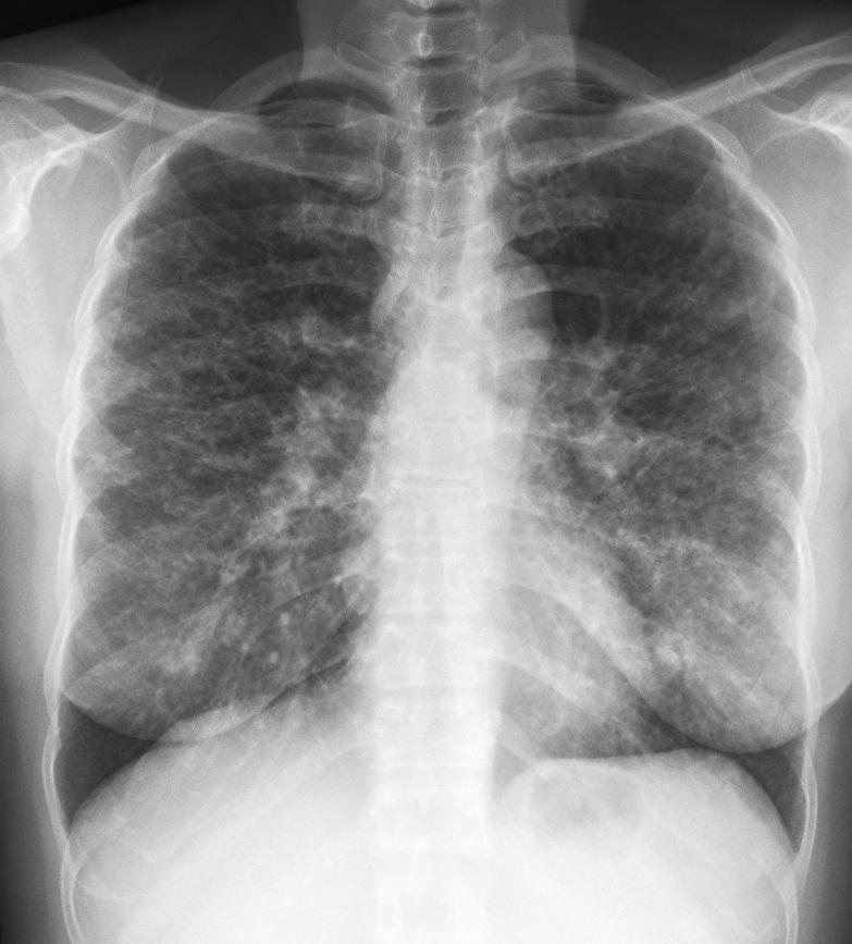 Quizz 20 On a une opacité diffuse aux deux poumons avec des réticulations et des
