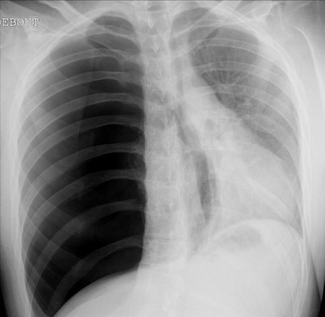 I. Radiographie thoracique: Les grands syndromes pulmonaires (part. II) Quizz 1 On a une opacité basale gauche homogène qui recouvre la coupole diaphragmatique et un comblement du CDS pleural gche.
