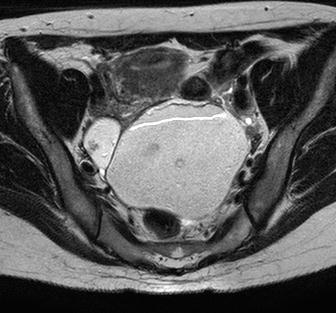 Patiente de 37ans, découverte en post partum d une masse pelvienne Pas d élévation des marqueurs tumoraux Volumineuse lésion kystique