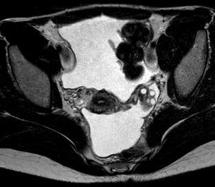 Lésion uniloculaire Ascite Ccl IRM : tumeur mucineuse avec suspicion