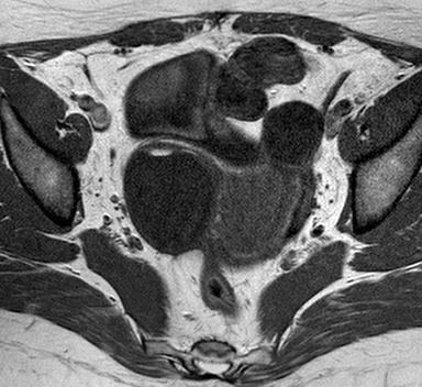 aménorrhée secondaire Kyste ovarien droit