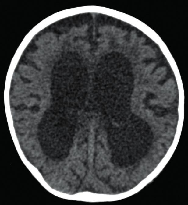Dossier scientifique Figures 8a et 8b Scanner cérébral non injecté montrant une dilatation ventriculaire et atrophie corticosous-corticale chez un enfant de 11 mois avec une angiostrongylose nerveuse.