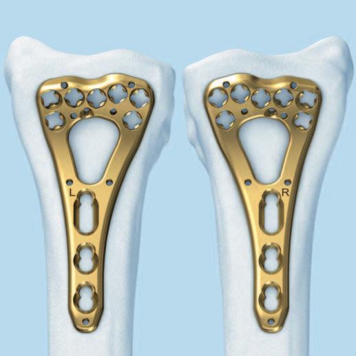 Implantation 1 Sélection de l implant Sélectionner la plaque en fonction de la configuration de la fracture et de l anatomie du radius.