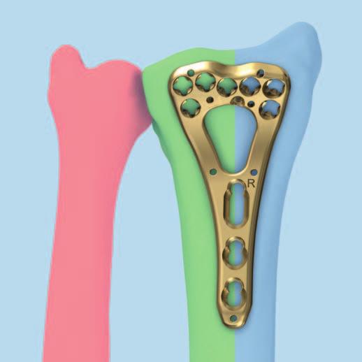 Théorie des trois colonnes Le traitement des fractures du radius distal nécessite une reconstitution méticuleuse de la surface articulaire, une fixation interne stable et un traitement fonctionnel