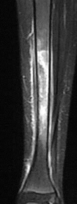 les lésions ostéitiques se situent préférentiellement dans la métaphyse des os longs (tibia++++), la