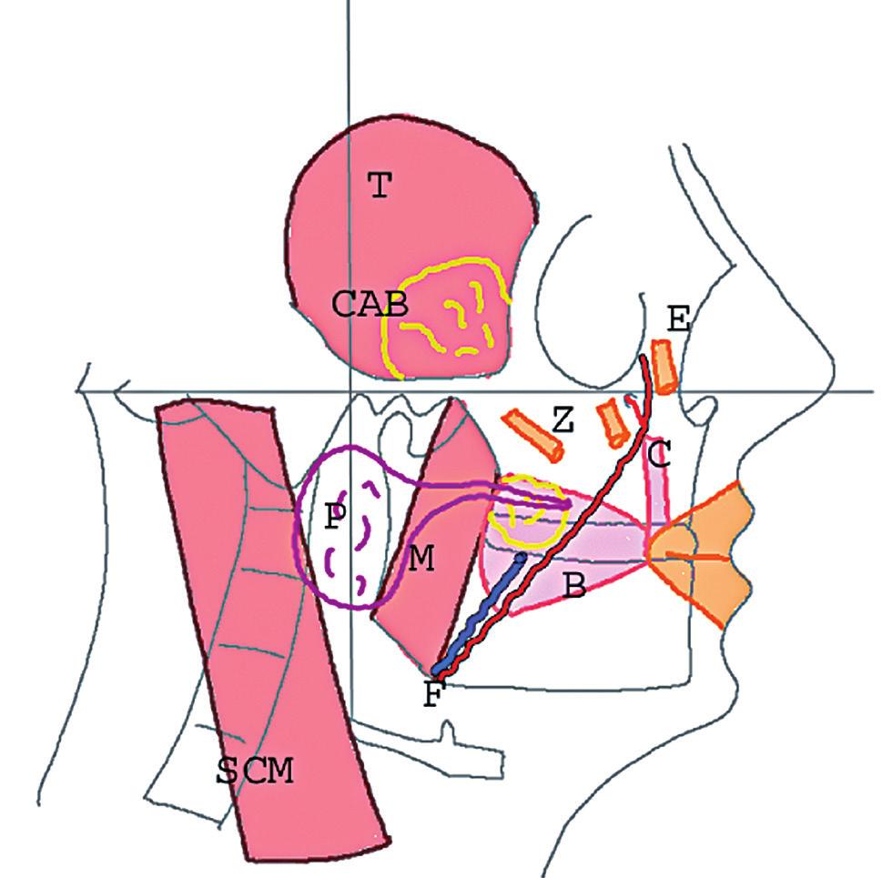 Spécial anatomie Vacher C. INTRODUCTION Le sinus maxillaire est une cavité aérique développée dans le maxillaire à partir d une évagination de la muqueuse nasale.