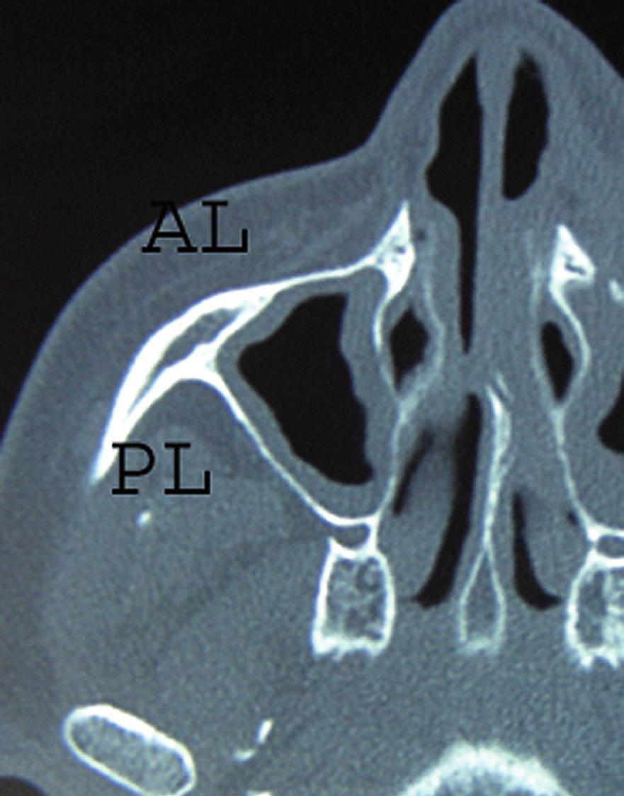 Spécial anatomie Vacher C. les nœuds lymphatiques du pédicule facial dans la région sub-mandibulaire, et les nœuds lymphatiques rétro-pharyngiens pour ce qui est de la parie postérieure du sinus.