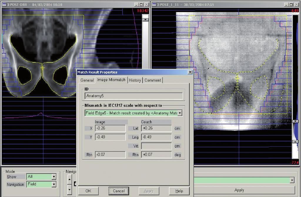Page 13 Tableau 10. Principes de l imagerie portale embarquée. Comparaison image de référence (à gauche) et image de contrôle (à droite) pour un faisceau antérieur pour un traitement de la prostate.