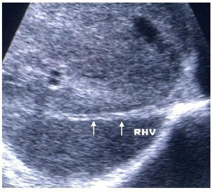 circulatoires Scanner hépatique: - obstruction VH; CVC
