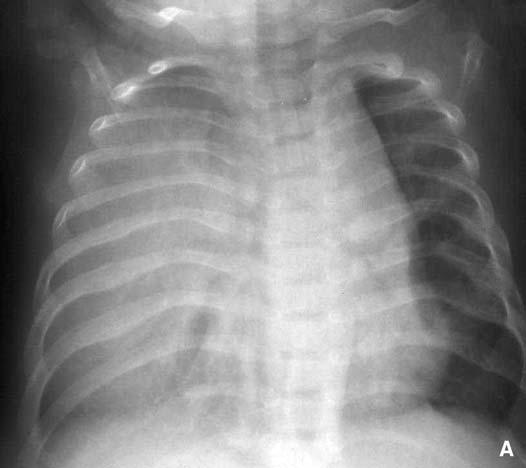 32-540-A-10 Médiastin chez l enfant (hors cœur et vaisseaux) Figure 23. Hernie thymique cervicale (enfant de 6 mois). A. Radiographie du cou de profil démontrant une tuméfaction sus-sternale. B.