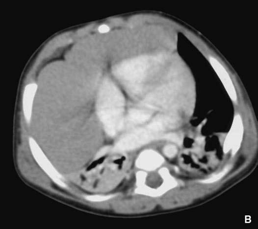 Radiographie du thorax. B. Tomodensitométrie avec contraste. lymphomateuses sous traitement chimiothérapique (Fig. 33). À l arrêt du traitement, un rebond thymique (cf.