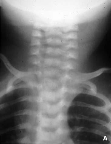 Médiastin chez l enfant (hors cœur et vaisseaux) 32-540-A-10 Figure 30. Tératome cervicomédiastinal (enfant de 3 ans). A. Radiographie de face : déviation de la trachée vers la droite. B.