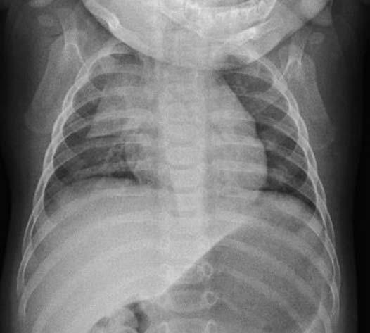 Médiastin antérieur Il est situé entre le sternum d une part, le cœur et les gros vaisseaux de l autre. La structure principale de ce compartiment est le thymus.