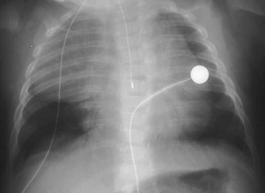 Médiastin chez l enfant (hors cœur et vaisseaux) 32-540-A-10 Figure 9. Thymus pseudotumoral. Radiographie du thorax (enfant de 6 mois).